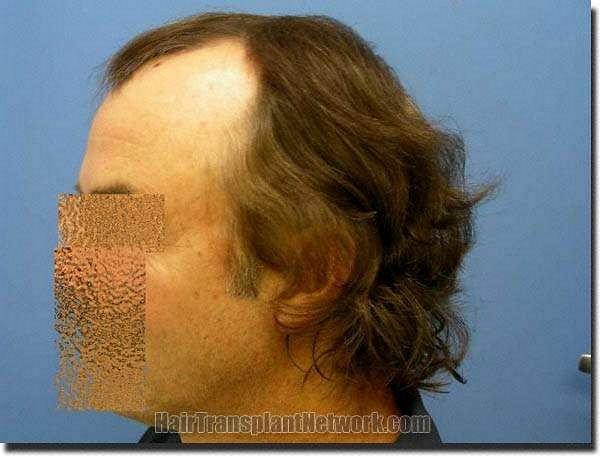 Hair restoration procedure results