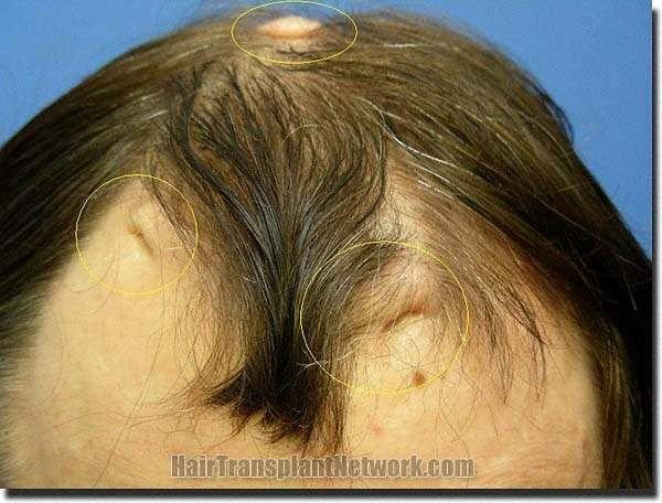 Hair restoration procedure results