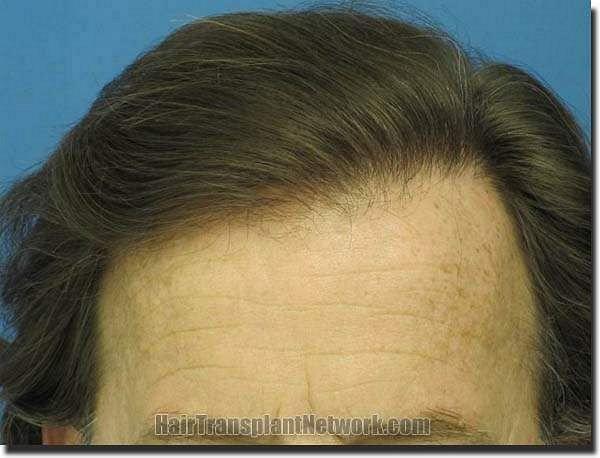 Hair restoration procedure results