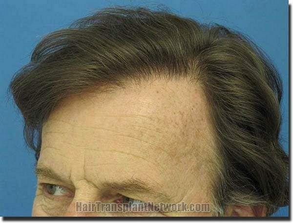 Hair restoration procedure results