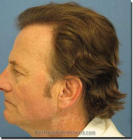 Hair restoration procedure results