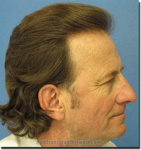 Hair restoration procedure results