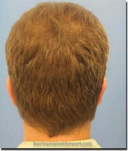 Hair restoration procedure results