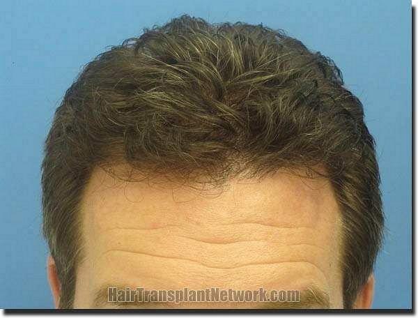 Hair restoration procedure results