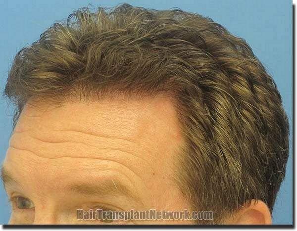 Hair restoration procedure results