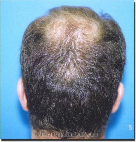 Hair restoration procedure results