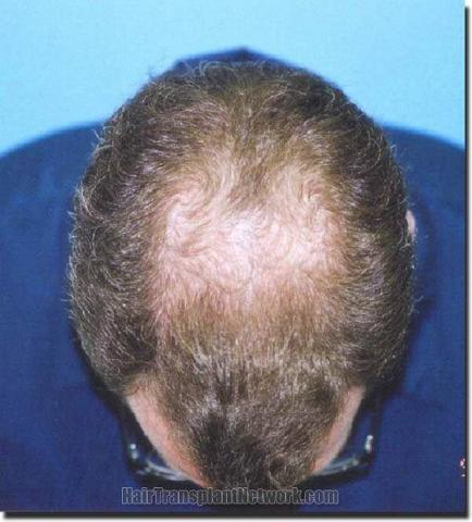 Hair restoration procedure results