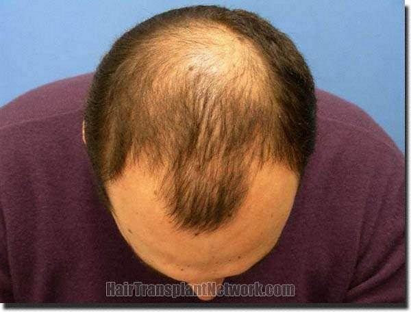 Hair restoration procedure results