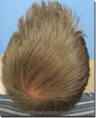 Hair restoration procedure results