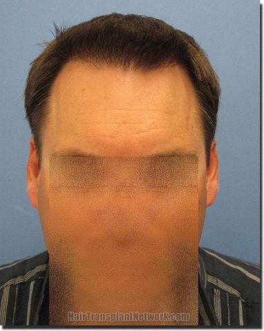 Hair restoration procedure results