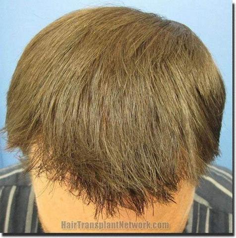 Hair restoration procedure results