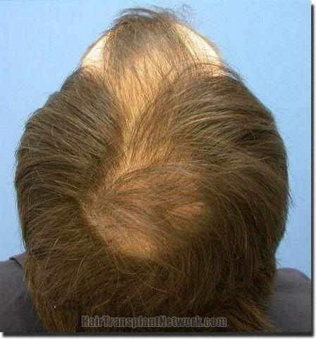 Hair restoration procedure results