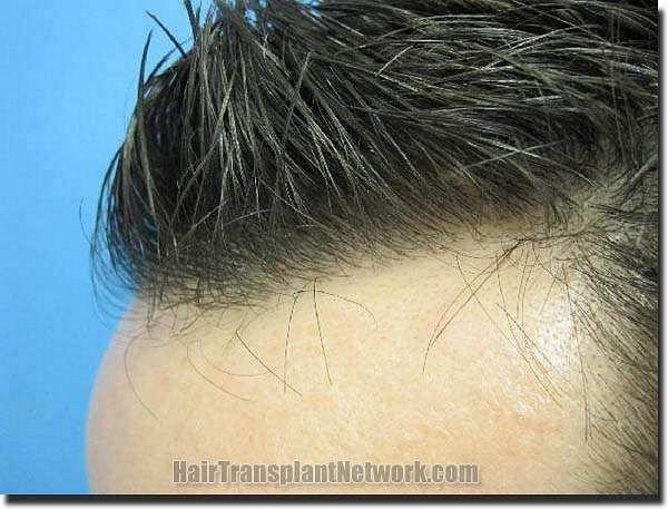 Hair restoration procedure results