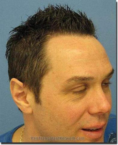 Hair restoration procedure results