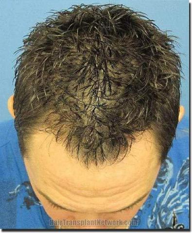 Hair restoration procedure results