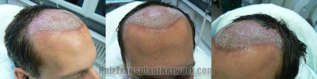 Hair transplantation surgery before and after photos