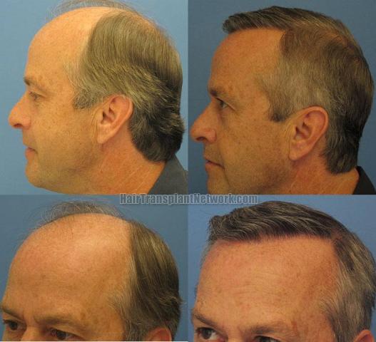 Left view before and after hair restoration pictures