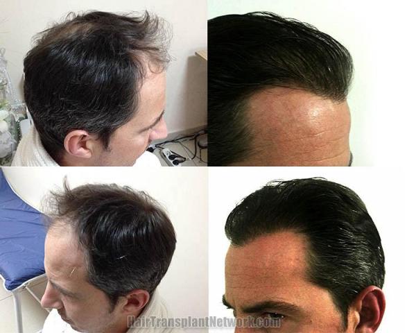 Hair restoration procedure before and after result photographs