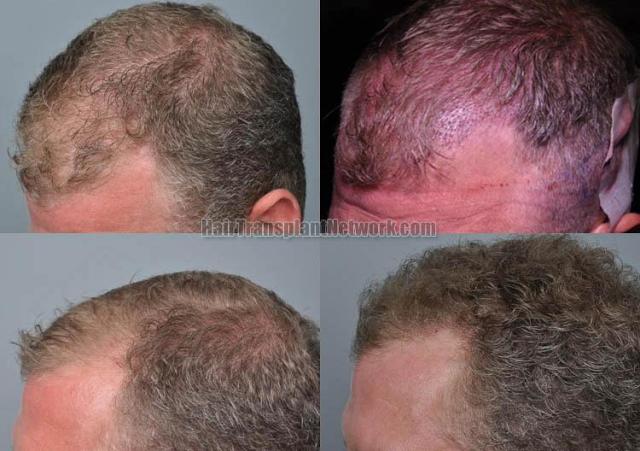 Hair transplantation surgery before and after pictures