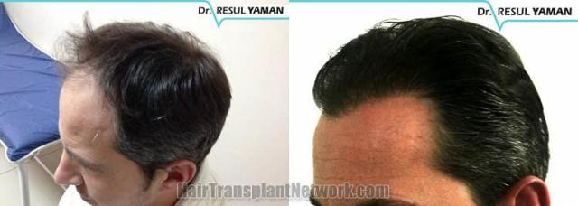 Hair transplant surgery before and after photos