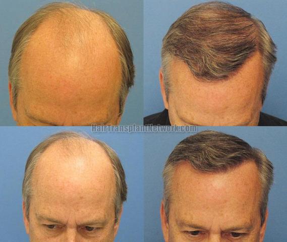 Top view pictures before and after hair transplant