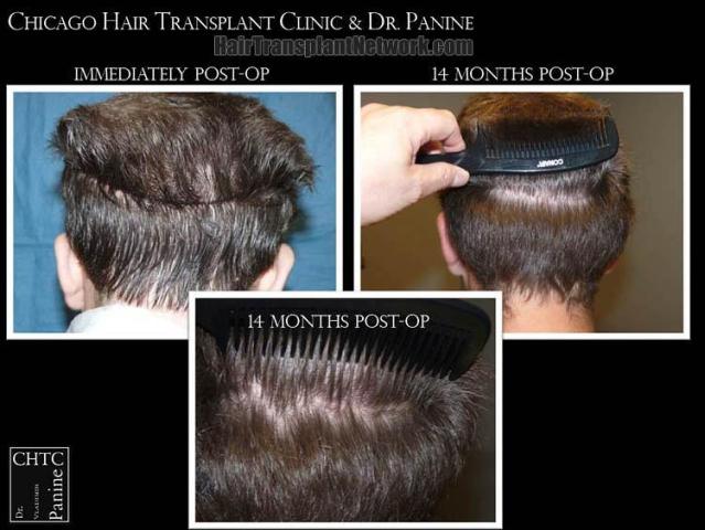 Hair restoration surgery before and after photos