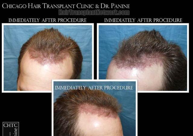 Hair restoration procedure before and after pictures