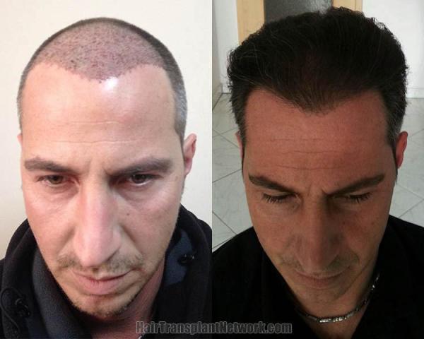 Hair restoration procedure before and after pictures