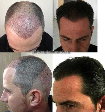 Hair restoration procedure before and after result photographs