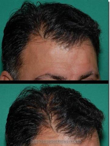 Hair restoration procedure results