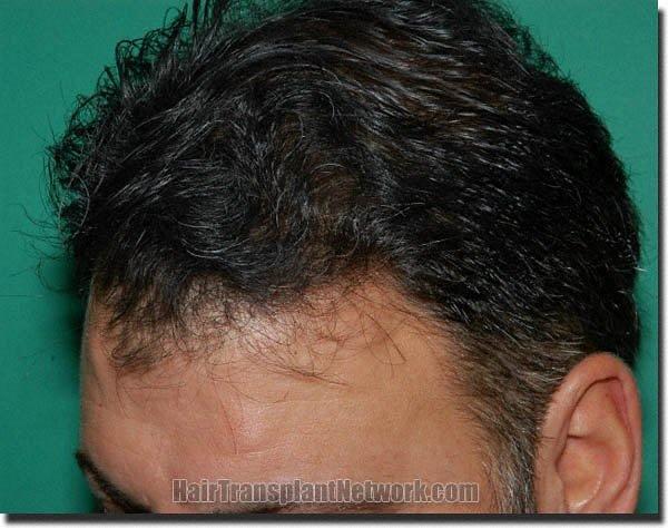 Hair restoration procedure results