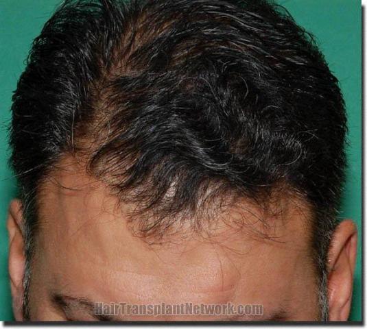 Hair restoration procedure results