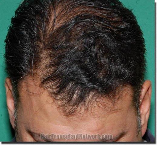 Hair restoration procedure results