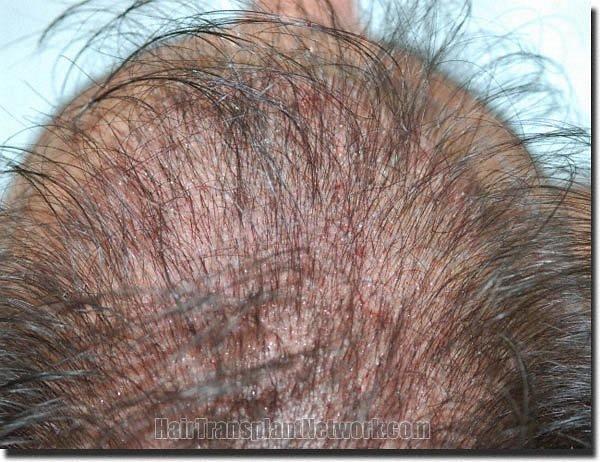 Hair restoration procedure results