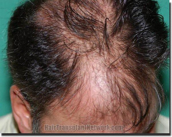 Hair restoration procedure results