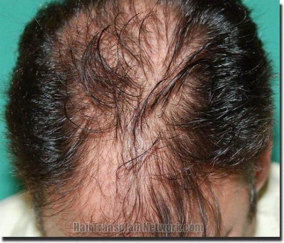 Hair restoration procedure results