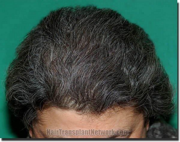 Hair restoration procedure results