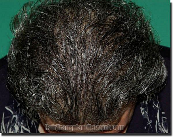 Hair restoration procedure results