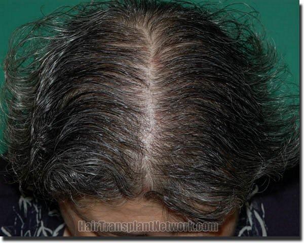 Hair restoration procedure results