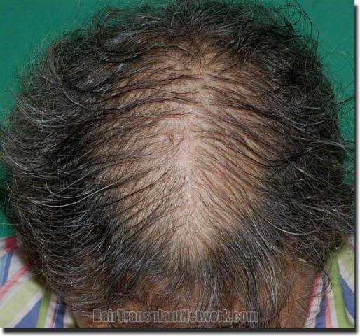 Hair restoration procedure results