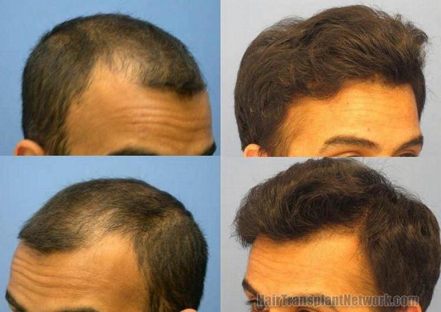 Closeup of pictures showing patients restored left and right hairlines