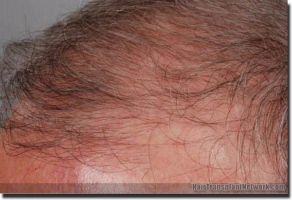 Hair restoration procedure results