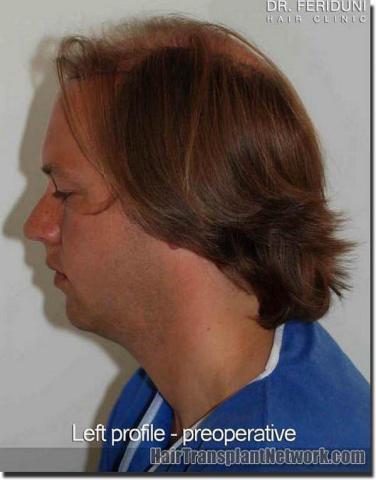 Hair restoration procedure results