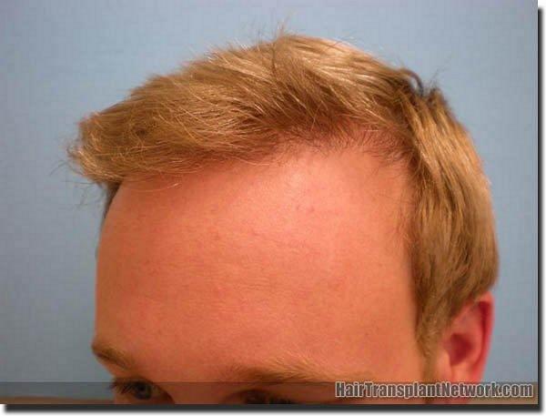 Hair restoration procedure results