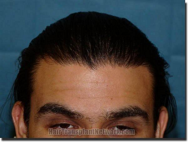 Hair restoration procedure results