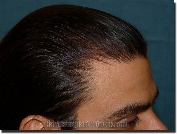 Hair restoration procedure results