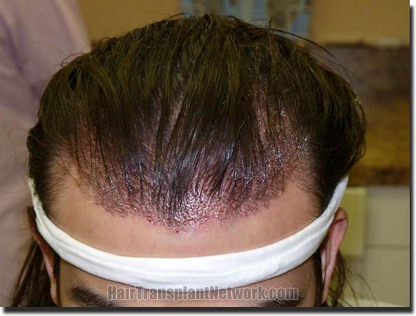 Hair restoration procedure results