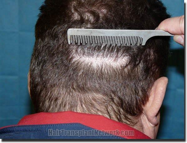 Hair restoration procedure results