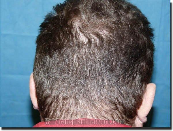 Hair restoration procedure results