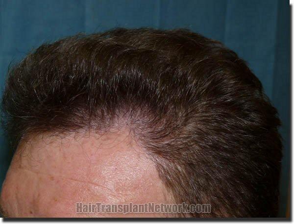 Hair restoration procedure results